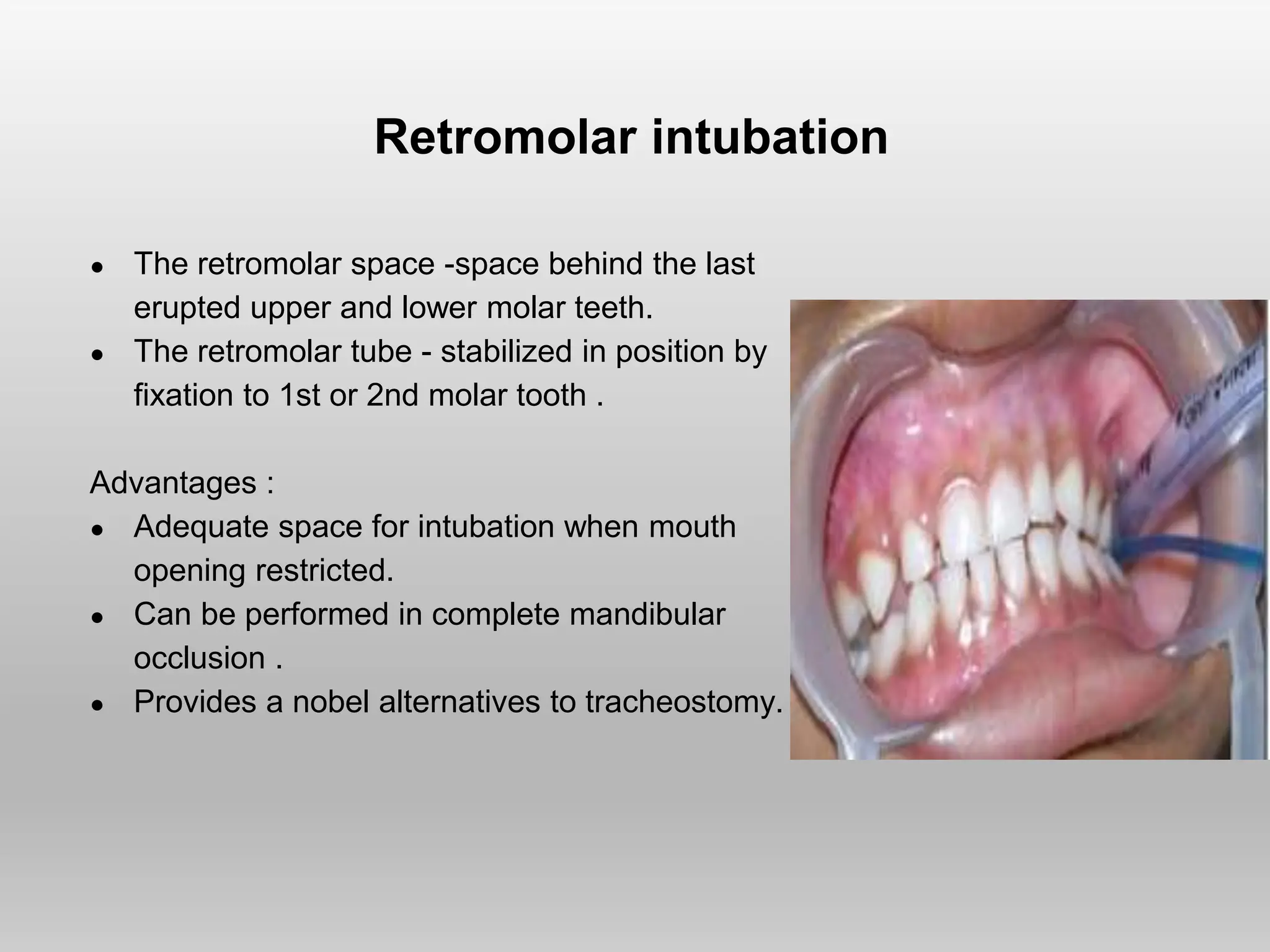 Retromolar intubation
● The retromolar space -space behind the last
erupted upper and lower molar teeth.
● The retromolar tube - stabilized in position by
fixation to 1st or 2nd molar tooth .
Advantages :
● Adequate space for intubation when mouth
opening restricted.
● Can be performed in complete mandibular
occlusion .
● Provides a nobel alternatives to tracheostomy.
 