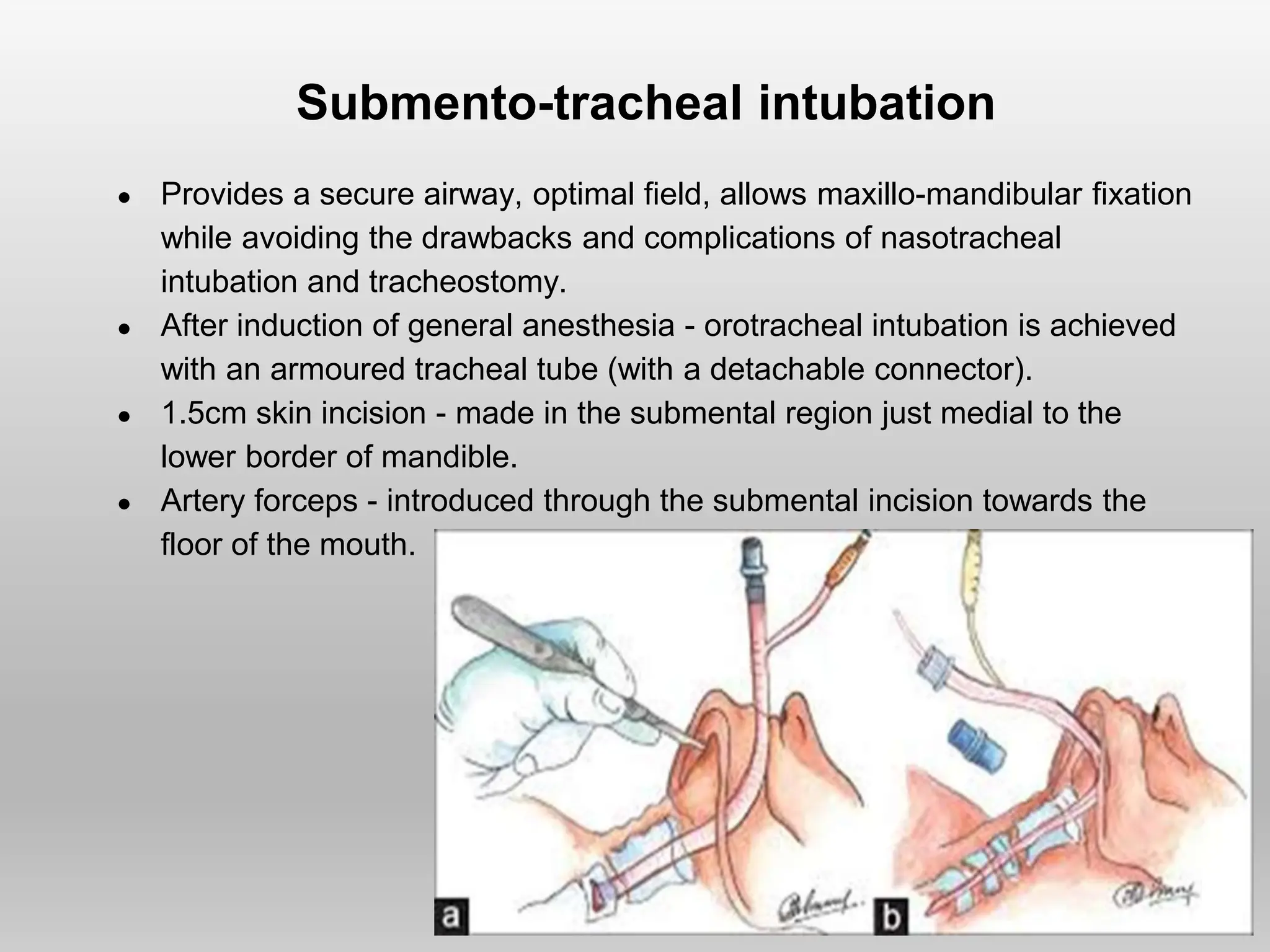 Submento-tracheal intubation
● Provides a secure airway, optimal field, allows maxillo-mandibular fixation
while avoiding the drawbacks and complications of nasotracheal
intubation and tracheostomy.
● After induction of general anesthesia - orotracheal intubation is achieved
with an armoured tracheal tube (with a detachable connector).
● 1.5cm skin incision - made in the submental region just medial to the
lower border of mandible.
● Artery forceps - introduced through the submental incision towards the
floor of the mouth.
 