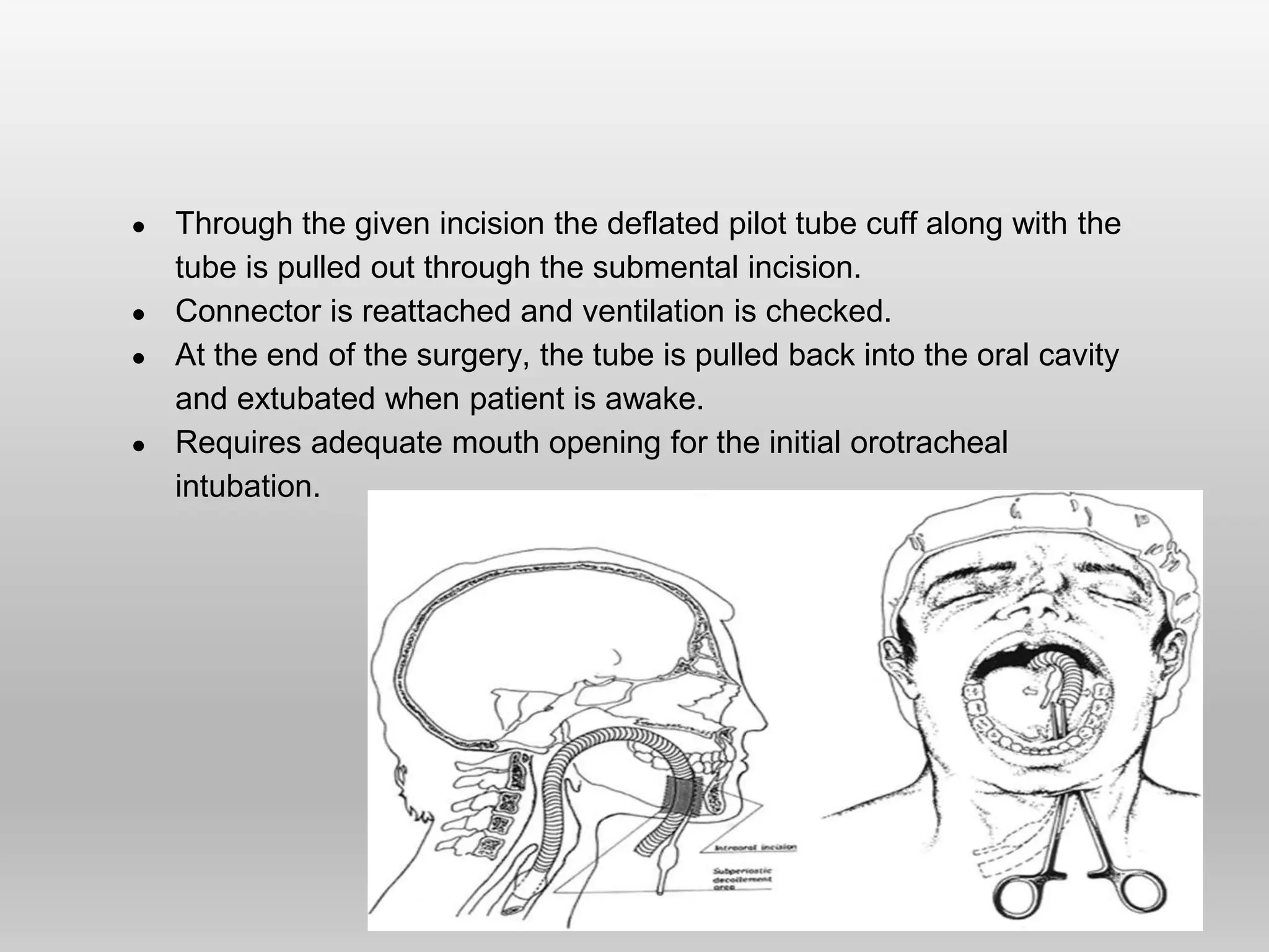 ● Through the given incision the deflated pilot tube cuff along with the
tube is pulled out through the submental incision.
● Connector is reattached and ventilation is checked.
● At the end of the surgery, the tube is pulled back into the oral cavity
and extubated when patient is awake.
● Requires adequate mouth opening for the initial orotracheal
intubation.
 