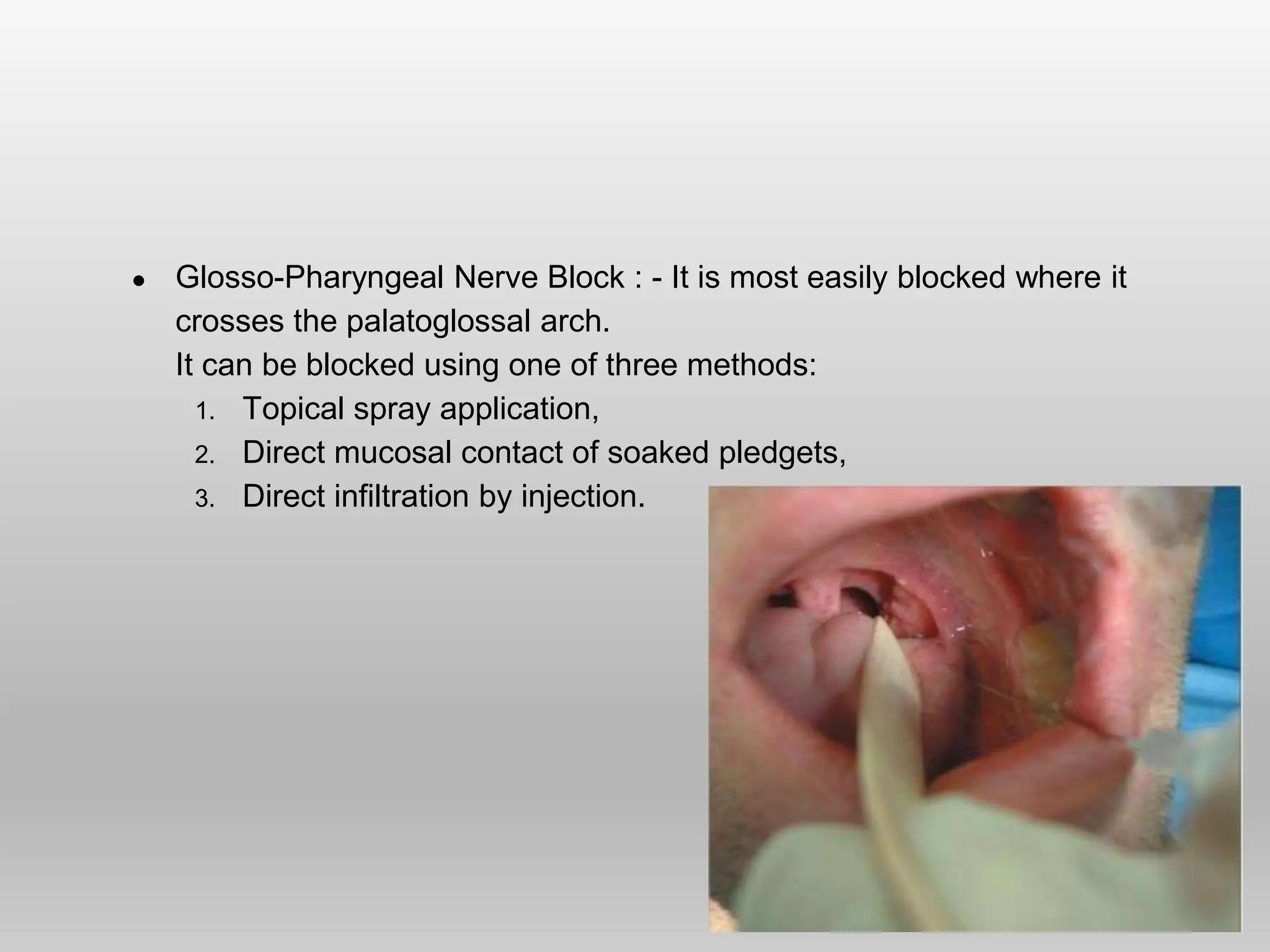 ● Glosso-Pharyngeal Nerve Block : - It is most easily blocked where it
crosses the palatoglossal arch.
It can be blocked using one of three methods:
1. Topical spray application,
2. Direct mucosal contact of soaked pledgets,
3. Direct infiltration by injection.
 