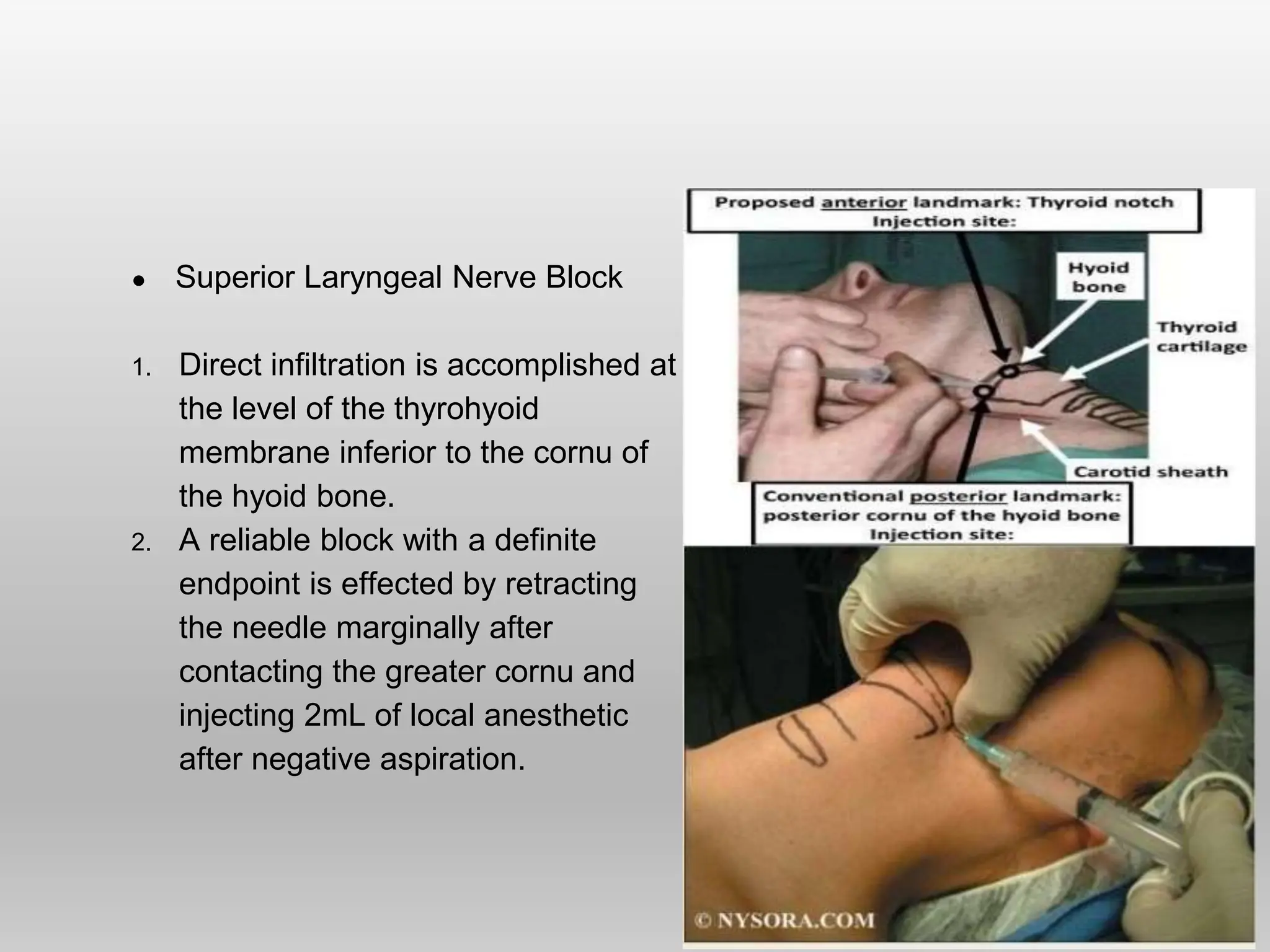 ● Superior Laryngeal Nerve Block
1. Direct infiltration is accomplished at
the level of the thyrohyoid
membrane inferior to the cornu of
the hyoid bone.
2. A reliable block with a definite
endpoint is effected by retracting
the needle marginally after
contacting the greater cornu and
injecting 2mL of local anesthetic
after negative aspiration.
 