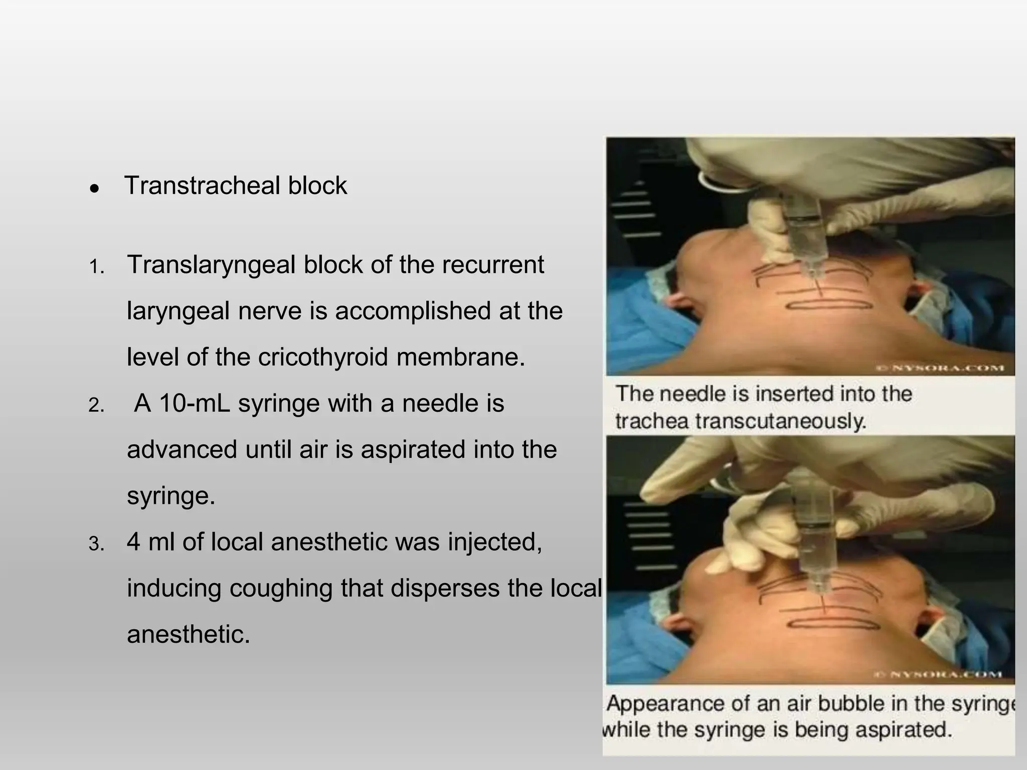 ● Transtracheal block
1. Translaryngeal block of the recurrent
laryngeal nerve is accomplished at the
level of the cricothyroid membrane.
2. A 10-mL syringe with a needle is
advanced until air is aspirated into the
syringe.
3. 4 ml of local anesthetic was injected,
inducing coughing that disperses the local
anesthetic.
 