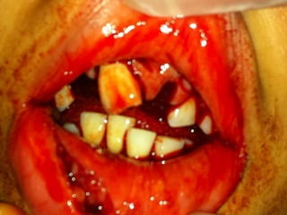 Dental emergencies