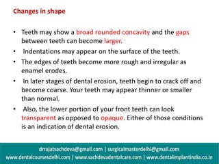 Dental Erosion , Senstivity