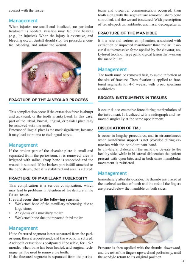 Complications occur During Dental Extraction and their Management