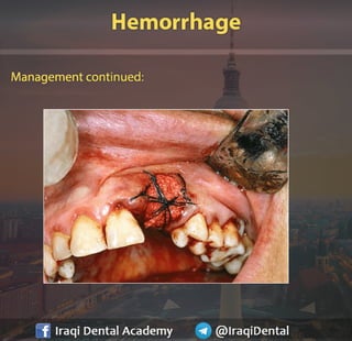 Most common Complications during Dental Extraction: Explained