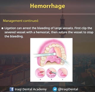 Most common Complications during Dental Extraction: Explained