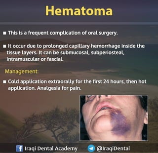 Most common Complications during Dental Extraction: Explained