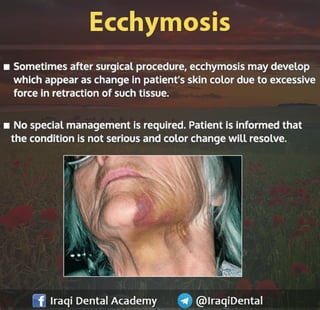 Most common Complications during Dental Extraction: Explained