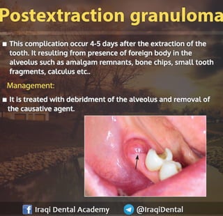 Most common Complications during Dental Extraction: Explained