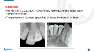31
Radiograph:
• the roots of 11, 21, 31,41, 42 were fully formed, and the apices were
completely closed.
• The periodontal ligament space had widened by more than 5mm
 