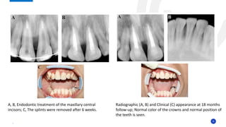 35
Radiographic (A, B) and Clinical (C) appearance at 18 months
follow-up; Normal color of the crowns and normal position of
the teeth is seen.
A, B, Endodontic treatment of the maxillary central
incisors; C, The splints were removed after 6 weeks.
 