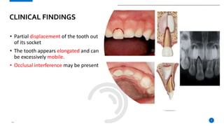• Partial displacement of the tooth out
of its socket
• The tooth appears elongated and can
be excessively mobile.
• Occlusal interference may be present
7
CLINICAL FINDINGS
 