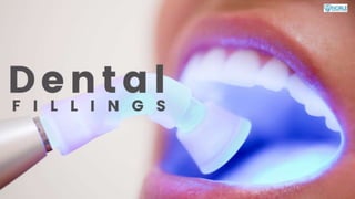 Dental Fillings.pptx