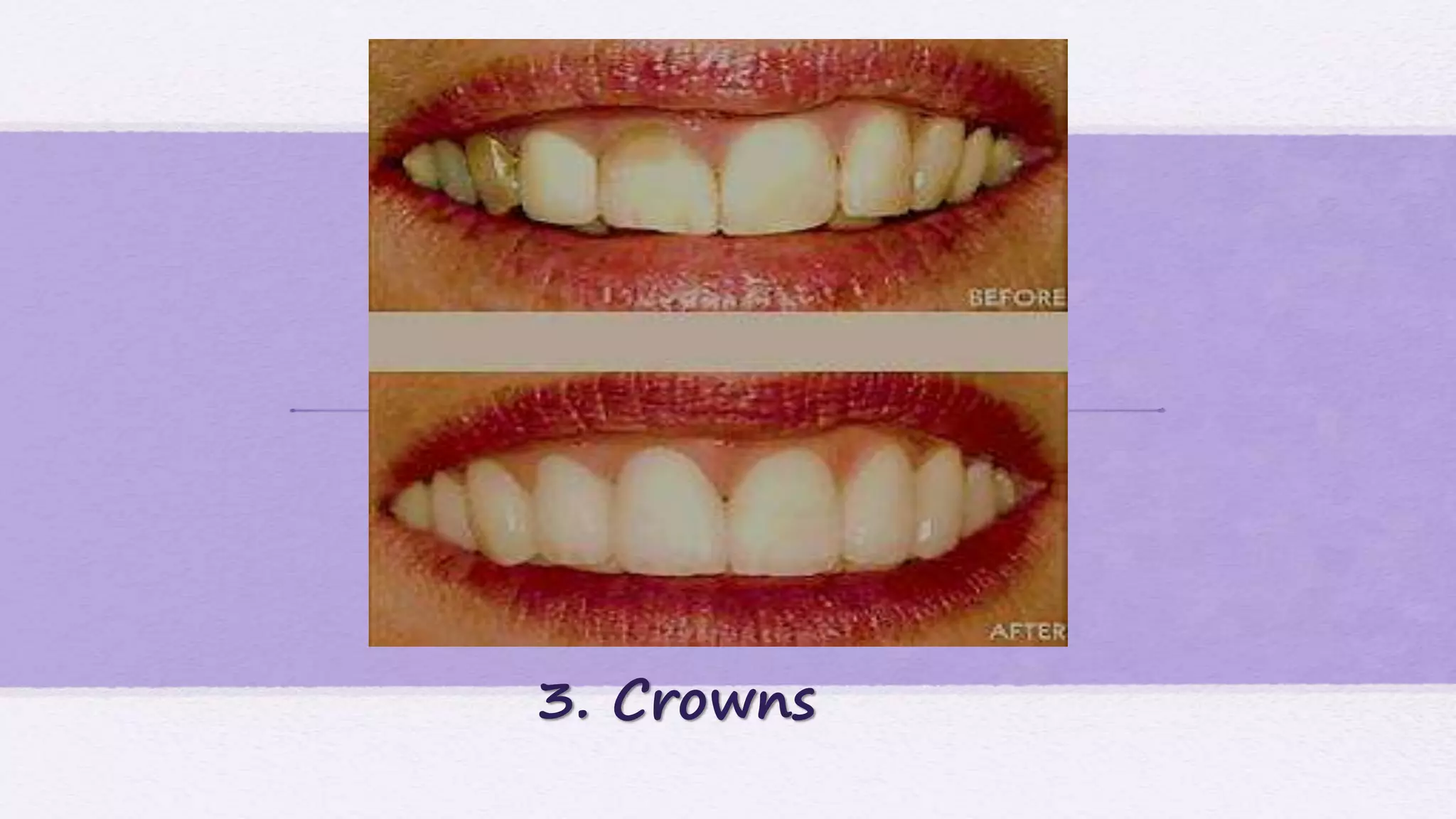 3. Crowns
 