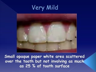 Small opaque paper white area scattered
over the tooth but not involving as much
as 25 % of tooth surface
 
