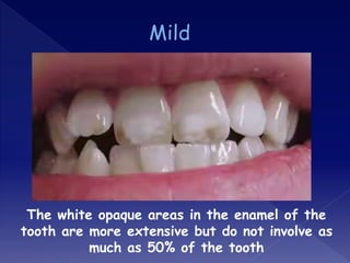 The white opaque areas in the enamel of the
tooth are more extensive but do not involve as
much as 50% of the tooth
 