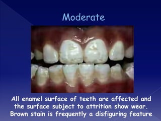 All enamel surface of teeth are affected and
the surface subject to attrition show wear.
Brown stain is frequently a disfiguring feature
 