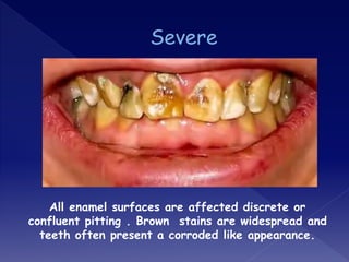 All enamel surfaces are affected discrete or
confluent pitting . Brown stains are widespread and
teeth often present a corroded like appearance.
 