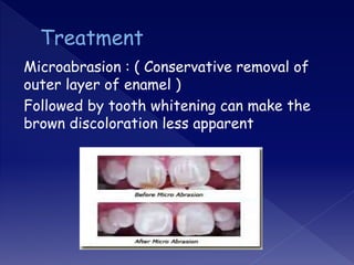 Microabrasion : ( Conservative removal of
outer layer of enamel )
Followed by tooth whitening can make the
brown discoloration less apparent
 
