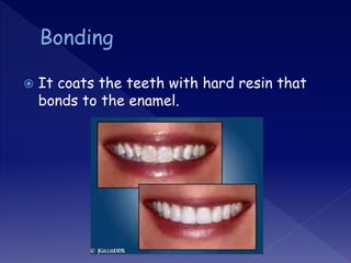  It coats the teeth with hard resin that
bonds to the enamel.
 