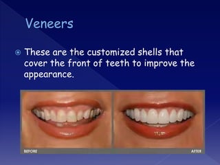  These are the customized shells that
cover the front of teeth to improve the
appearance.
 