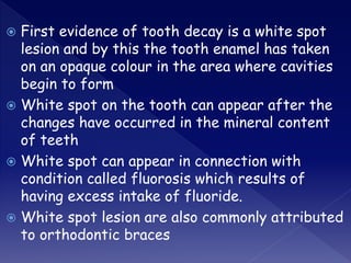  First evidence of tooth decay is a white spot
lesion and by this the tooth enamel has taken
on an opaque colour in the area where cavities
begin to form
 White spot on the tooth can appear after the
changes have occurred in the mineral content
of teeth
 White spot can appear in connection with
condition called fluorosis which results of
having excess intake of fluoride.
 White spot lesion are also commonly attributed
to orthodontic braces
 