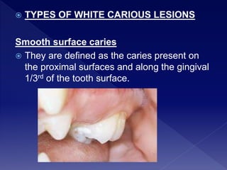  TYPES OF WHITE CARIOUS LESIONS
Smooth surface caries
 They are defined as the caries present on
the proximal surfaces and along the gingival
1/3rd of the tooth surface.
 