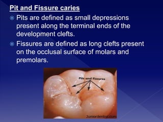 Pit and Fissure caries
 Pits are defined as small depressions
present along the terminal ends of the
development clefts.
 Fissures are defined as long clefts present
on the occlusal surface of molars and
premolars.
 
