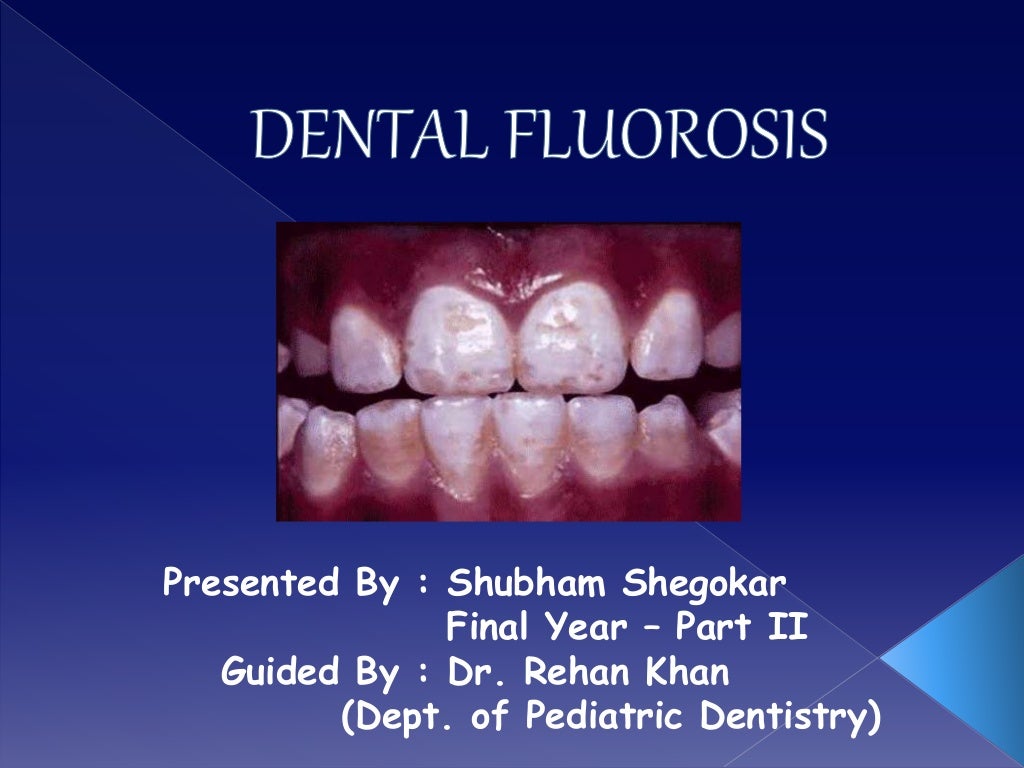 Overview on Dental fluorosis
