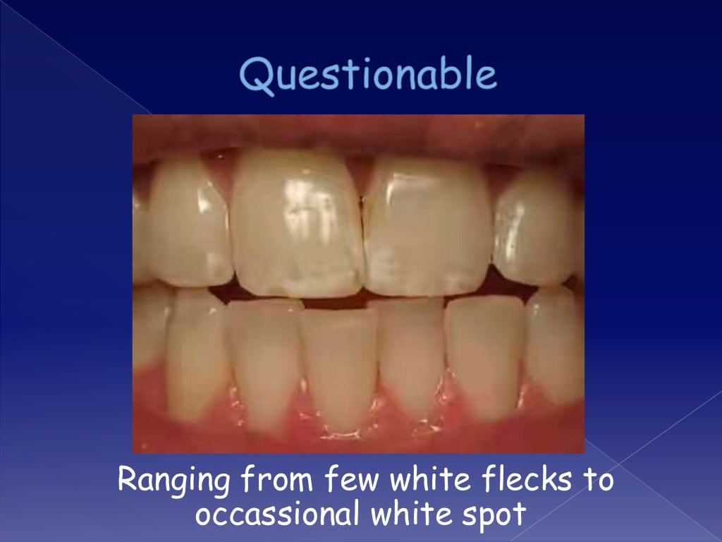 Overview on Dental fluorosis