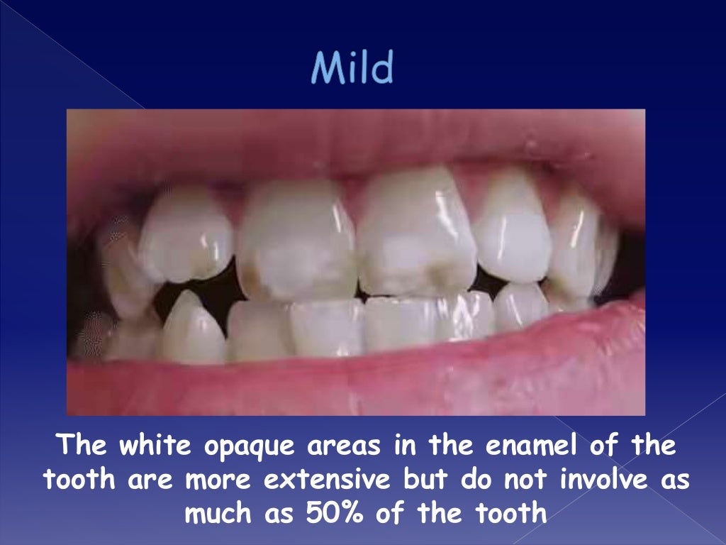Overview on Dental fluorosis
