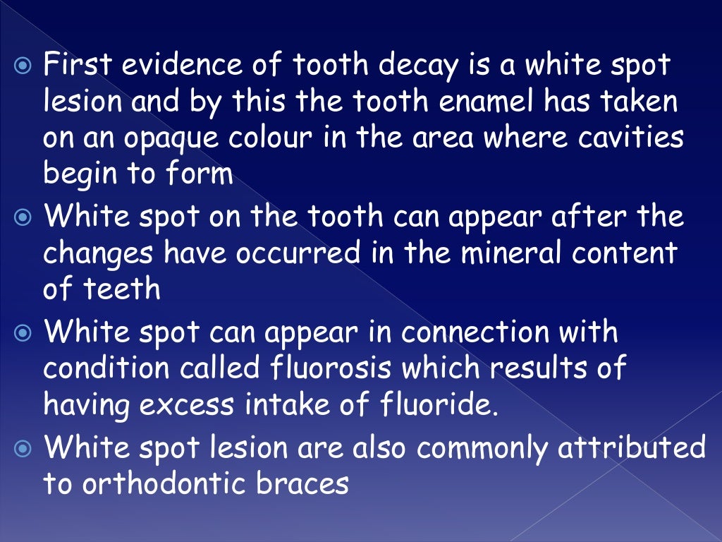 Overview on Dental fluorosis