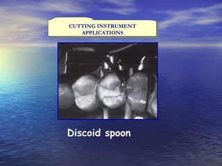 CUTTING INSTRUMENT APPLICATIONS Discoid spoon  