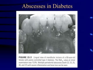 Abscesses in Diabetes
 