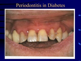 Periodontitis in Diabetes
 