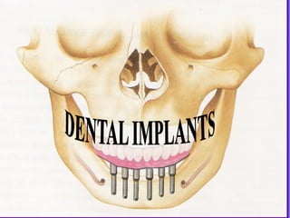 Tooth Im Plan Example Dental_I mplan.ppt