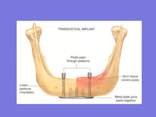 Tooth Im Plan Example Dental_I mplan.ppt