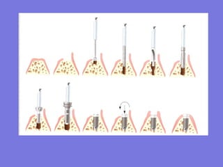 Tooth Im Plan Example Dental_I mplan.ppt
