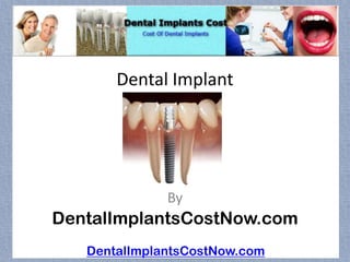 Dental Implant




              By
DentalImplantsCostNow.com
   DentalImplantsCostNow.com
 