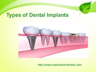 Types of Dental Implants

http://www.hyderabad-dentist.com

 