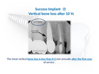 The mean vertical bone loss is less than 0.2 mm annually after the first year
of service .
Success Implant 
Vertical bone loss after 10 Ys
 