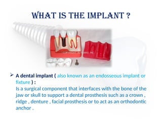 What is the implant ?
 A dental implant ( also known as an endosseous implant or
fixture ) :
Is a surgical component that interfaces with the bone of the
jaw or skull to support a dental prosthesis such as a crown ,
ridge , denture , facial prosthesis or to act as an orthodontic
anchor .
 