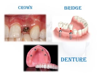 Crown Bridge
Denture
 
