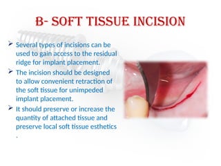 b- soft tissue Incision
 Several types of incisions can be
used to gain access to the residual
ridge for implant placement.
 The incision should be designed
to allow convenient retraction of
the soft tissue for unimpeded
implant placement.
 It should preserve or increase the
quantity of attached tissue and
preserve local soft tissue esthetics
.
 