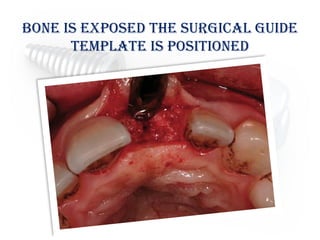 bone is exposed the surgical guide
template is positioned
 