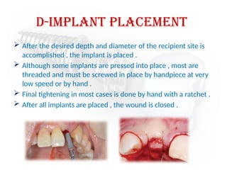 d-implant placement
 After the desired depth and diameter of the recipient site is
accomplished , the implant is placed .
 Although some implants are pressed into place , most are
threaded and must be screwed in place by handpiece at very
low speed or by hand .
 Final tightening in most cases is done by hand with a ratchet .
 After all implants are placed , the wound is closed .
 