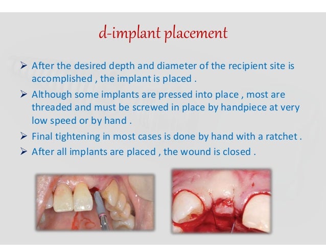 Dental implant