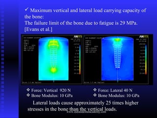  Maximum vertical and lateral load carrying capacity of
the bone:
The failure limit of the bone due to fatigue is 29 MPa....