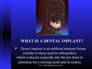 WHAT IS A DENTAL IMPLANT?
 Dental implant is an artificial titanium fixture
(similar to those used in orthopedics)
which ...
